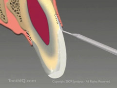 Image Source: http://www.toothiq.com/dental-images-thumb/240px-supracrestal-fiberotomy-tissue-trim-orthodontic-relapse-rotated-teeth.jpg