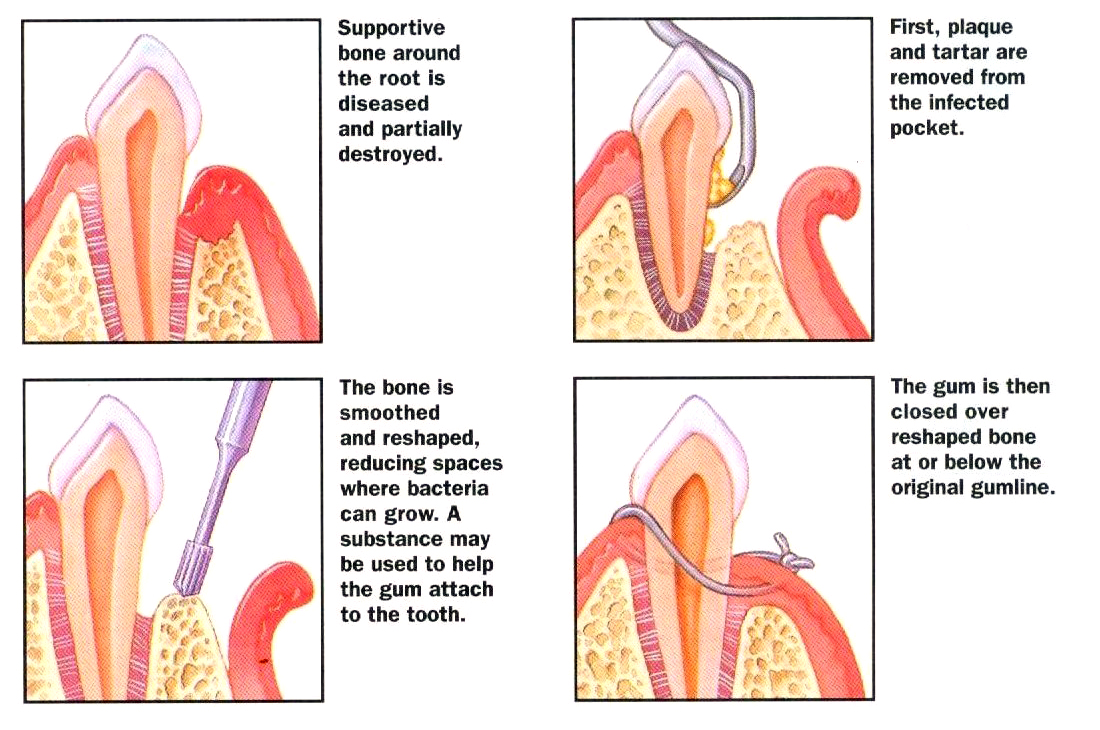 Image Source: http://www.periodontalhealthcenter.com/wp-content/uploads/2008/11/osseous-surgery.jpg